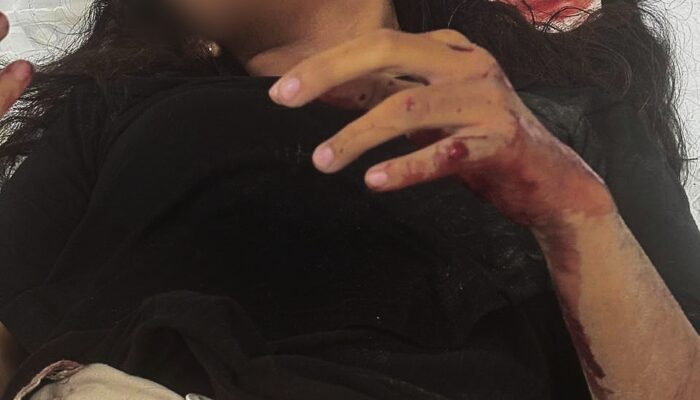 Wanita Alami Luka Parah Diduga Korban Penjambretan di Jalan Seroja, Timika